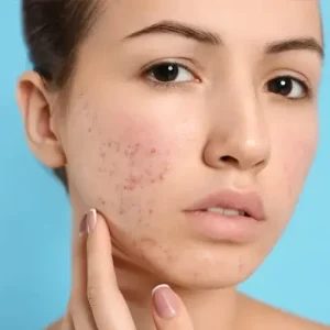 Acne Prone